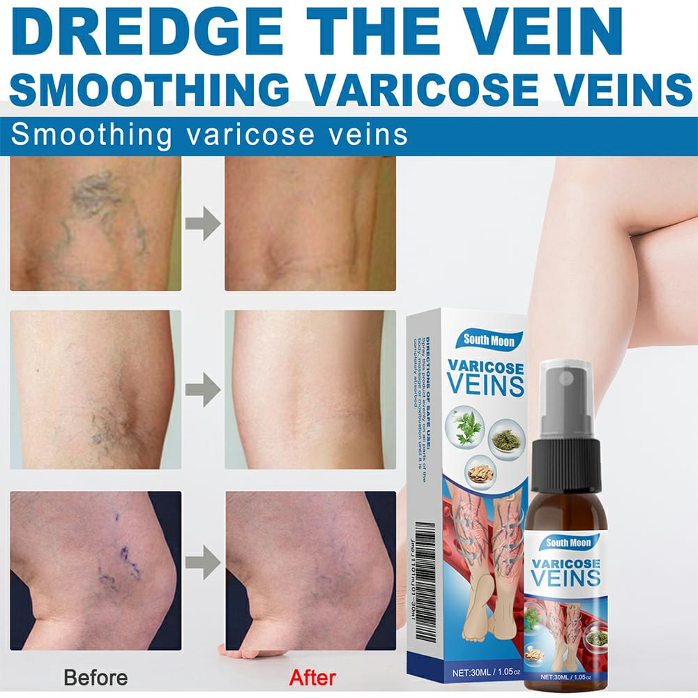 Varicose Veins Relief Spray – 30ml
